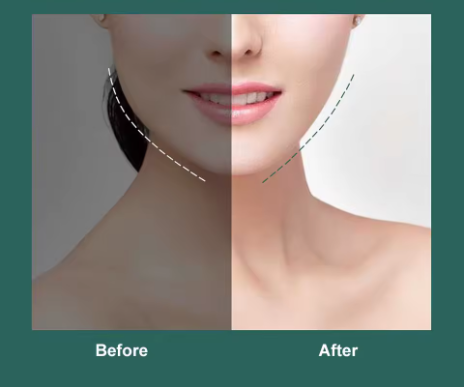 Face Lift Up Belt
